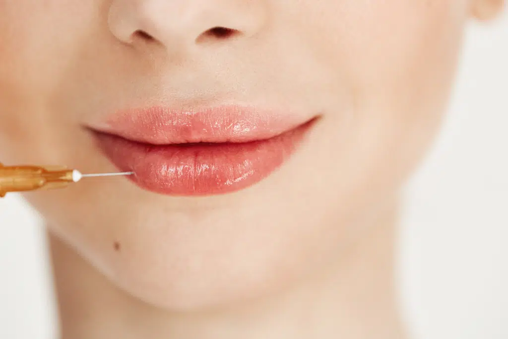 Should You Follow the Lip Filler Trend? Read This Before You Decide
