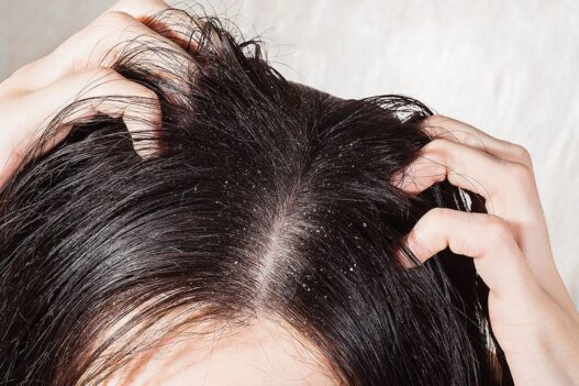 Winter and Scalp Itches? Try These Powerful Home Remedies for Dandruff