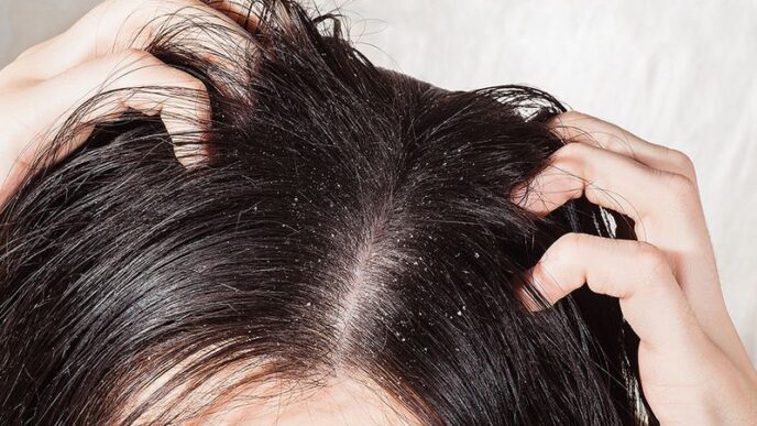 Winter and Scalp Itches? Try These Powerful Home Remedies for Dandruff